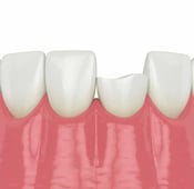 تكسر الأسنان: الأسباب والعلاج