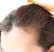 زراعة الشعر الايطالي: المميزات والعيوب والتكاليف