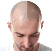 مراحل نمو الشعر المزروع بعد زراعة الشعر بالصور