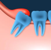 Benefits of keeping wisdom teeth and how to know if you need to remove them?