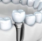 دليل التعافي الشامل بعد زراعة الأسنان