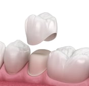 Reviews and Costs of Crowns, Dentures, and Bridges in Turkey