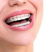 10 أضرار لتقويم الأسنان: تعرف عليها