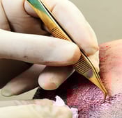 الفرق بين زراعة الشعر في ايران  وتركيا 2025