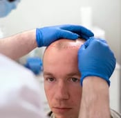 ماهي تقنية البيركوتان لزراعة الشعر وماهي أبرز مزاياها؟