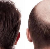 تجربة زراعة الشعر في تركيا