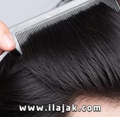 Hair Transplant without shaving in Turkey for women and men