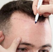 زراعة الشعر للرجال: الخطوات والنتائج والتكلفة 2025
