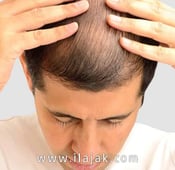 الفرق بين زراعة الشعر في تركيا و لندن 2025
