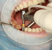 تعرف على عملية زراعة الاسنان بالصور وميزاتها و كيف تتم