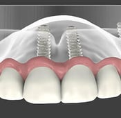 ما هي أشهر أخطاء زراعة الأسنان وكيف يتم التعامل معها؟
