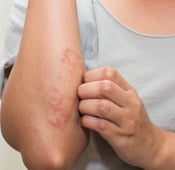 Traitement médicamenteux de l'eczéma