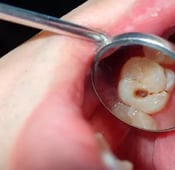 أعراض نقص الكالسيوم في الأسنان وكيفية علاجه