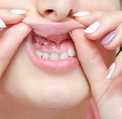 ما هي تقرحات اللثة، أسبابها وعلاجها؟