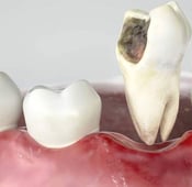 خلع الضرس: الأسباب مع نصائح لما بعد الخلع