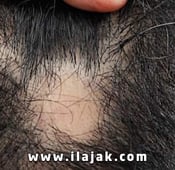 What is alopecia areata, what are the treatment methods, is it contagious?