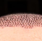 تكلفة زراعة الشعر بتقنية الاقتطاف FUE في تركيا 2025