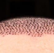 FUE hair transplantation in turkey reviews and cost