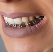 بروز الأسنان بعد التقويم: الأسباب وطرق العلاج