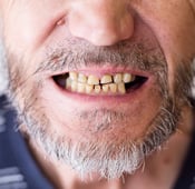 تآكل الأسنان: الأسباب والوقاية وطرق العلاج