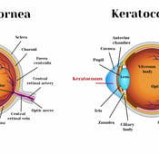 Keratoconus and cataracts , symptoms and types