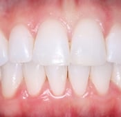 تركيب الأسنان الأمامية: الدليل الشامل 2024
