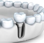 الفرق بين زراعة الاسنان وتركيب الاسنان
