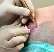 مخاطر زراعة الشعر: كيف تتجنب الأضرار والمضاعفات؟