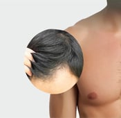 هل يمكن زراعة الشعر باستخدام شعر الجسم؟