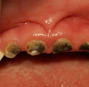 أسباب تسوس الأسنان عند الأطفال بعمر سنتين