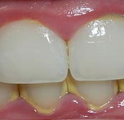 بلاك الأسنان: الأسباب وطرق العلاج