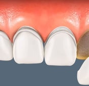 What is a veneer? - Veneers benefits and side effects