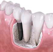 سقوط مسمار زراعة الأسنان : الأسباب والأعراض والحلول