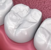 ما هي حشوات الأسنان التجميلية وما أنواعها؟