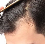 تساقط الشعر: أعراضه وأسبابه وطرق علاجه