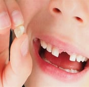 هل من الممكن علاج تخلخل الأسنان؟