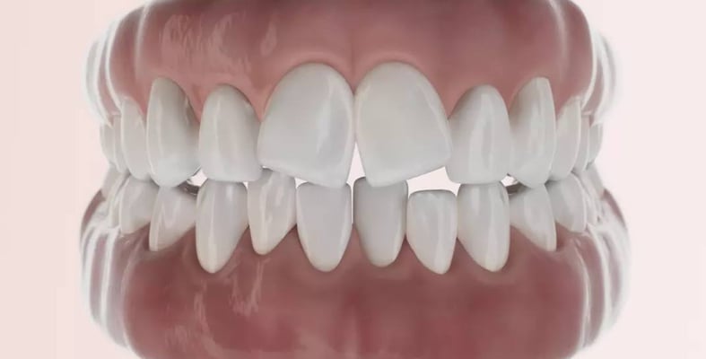 Gouttière Dentaire - Qu'est-ce que l'Invisalign? Turquie