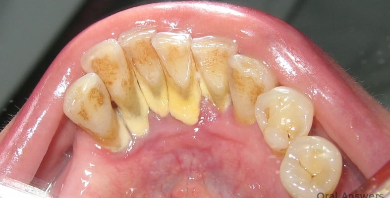 How to Remove Plaque from Teeth and Prevent Tartar Forming